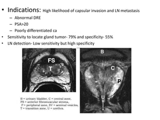 • Indications: High likelihood of capsular invasion and LN metastasis
– Abnormal DRE
– PSA>20
– Poorly differentiated ca
• Sensitivity to locate gland tumor- 79% and specificity- 55%
• LN detection- Low sensitivity but high specificity
 