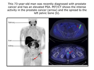 This 73-year-old man was recently diagnosed with prostate
cancer and has an elevated PSA. PET/CT shows the intense
activity in the prostate cancer (arrow) and the spread to the
left pelvic bone (b).
 