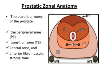 Prostatic Zonal Anatomy
• There are four zones
of the prostate :
 the peripheral zone
(PZ) ,
 transition zone (TZ) ,
 Central zone, and
 anterior fibromuscular
stroma zone.
 