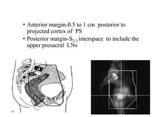 • Anterior margin-0.5 to 1 cm posterior to
projected cortex of PS
• Posterior margin-S2-3 interspace to include the
upper presacral LNs
 