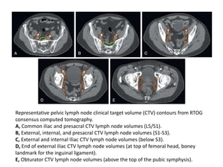 Representative pelvic lymph node clinical target volume (CTV) contours from RTOG
consensus computed tomography.
A, Common iliac and presacral CTV lymph node volumes (L5/S1).
B, External, internal, and presacral CTV lymph node volumes (S1-S3).
C, External and internal Iliac CTV lymph node volumes (below S3).
D, End of external iliac CTV lymph node volumes (at top of femoral head, boney
landmark for the inguinal ligament).
E, Obturator CTV lymph node volumes (above the top of the pubic symphysis).
 