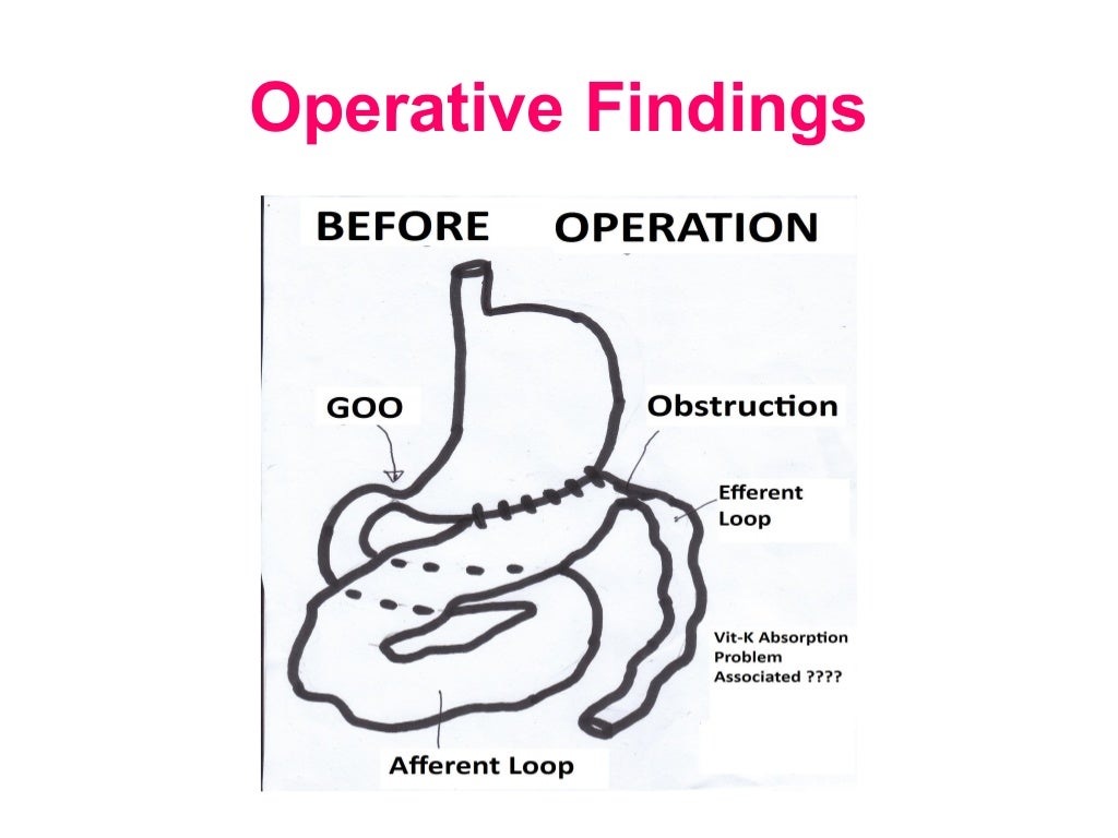 Post Operative (GastroJejunostomy) Efferent Loop Obstruction due to