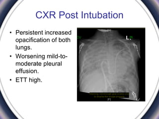 CXR Post Intubation
• Persistent increased
opacification of both
lungs.
• Worsening mild-to-
moderate pleural
effusion.
• ETT high.
 