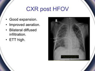 CXR post HFOV
• Good expansion.
• Improved aeration.
• Bilateral diffused
infiltration.
• ETT high.
 