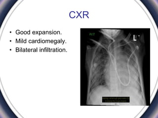 CXR
• Good expansion.
• Mild cardiomegaly.
• Bilateral infiltration.
 