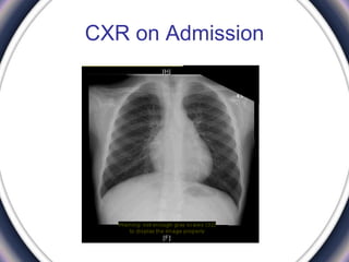 CXR on Admission
 