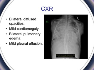 CXR
• Bilateral diffused
opacities.
• Mild cardiomegaly.
• Bilateral pulmonary
edema.
• Mild pleural effusion.
 
