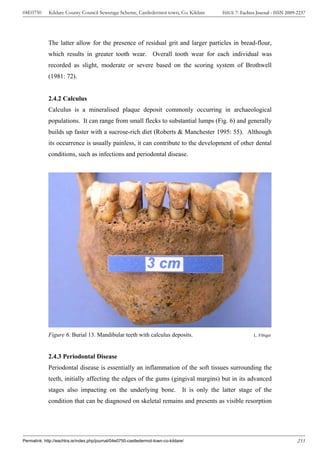 04E0750      Kildare County Council Sewerage Scheme, Castledermot town, Co. Kildare    ISSUE 7: Eachtra Journal - ISSN 2009-2237




             The latter allow for the presence of residual grit and larger particles in bread-flour,
             which results in greater tooth wear. Overall tooth wear for each individual was
             recorded as slight, moderate or severe based on the scoring system of Brothwell
             (1981: 72).


             2.4.2 Calculus
             Calculus is a mineralised plaque deposit commonly occurring in archaeological
             populations. It can range from small flecks to substantial lumps (Fig. 6) and generally
             builds up faster with a sucrose-rich diet (Roberts & Manchester 1995: 55). Although
             its occurrence is usually painless, it can contribute to the development of other dental
             conditions, such as infections and periodontal disease.




             Figure 6. Burial 13. Mandibular teeth with calculus deposits.                            L. Fibiger




             2.4.3 Periodontal Disease
             Periodontal disease is essentially an inflammation of the soft tissues surrounding the
             teeth, initially affecting the edges of the gums (gingival margins) but in its advanced
             stages also impacting on the underlying bone. It is only the latter stage of the
             condition that can be diagnosed on skeletal remains and presents as visible resorption




Permalink: http://eachtra.ie/index.php/journal/04e0750-castledermot-town-co-kildare/                                        233
 
