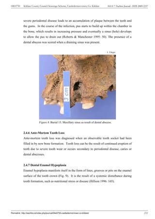 04E0750      Kildare County Council Sewerage Scheme, Castledermot town, Co. Kildare        ISSUE 7: Eachtra Journal - ISSN 2009-2237




             severe periodontal disease leads to an accumulation of plaque between the teeth and
             the gums. In the course of the infection, pus starts to build up within the chamber in
             the bone, which results in increasing pressure and eventually a sinus (hole) develops
             to allow the pus to drain out (Roberts & Manchester 1995: 50). The presence of a
             dental abscess was scored when a draining sinus was present.


                                                                                           L. Fibiger




                              Figure 8. Burial 13. Maxillary sinus as result of dental abscess.


             2.4.6 Ante-Mortem Tooth Loss
             Ante-mortem tooth loss was diagnosed when an observable tooth socket had been
             filled in by new bone formation. Tooth loss can be the result of continued eruption of
             teeth due to severe tooth wear or occurs secondary to periodontal disease, caries or
             dental abscesses.


             2.4.7 Dental Enamel Hypoplasia
             Enamel hypoplasia manifests itself in the form of lines, grooves or pits on the enamel
             surface of the tooth crown (Fig. 9). It is the result of a systemic disturbance during
             tooth formation, such as nutritional stress or disease (Hillson 1996: 165).




Permalink: http://eachtra.ie/index.php/journal/04e0750-castledermot-town-co-kildare/                                            235
 