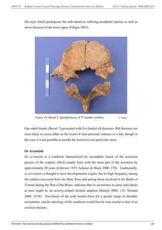 04E0750      Kildare County Council Sewerage Scheme, Castledermot town, Co. Kildare    ISSUE 7: Eachtra Journal - ISSN 2009-2237




             life-style which predisposes the individuals to suffering accidental injuries as well as
             stress fractures of the lower spine (Fibiger 2001).




                        Figure 16. Burial 2. Spondylolysis of 5th lumbar vertebra.          L. Fibiger




             One adult female (Burial 7) presented with five healed rib fractures. Rib fractures are
             most likely to occur either as the result of inter-personal violence or a fall, though in
             this case it is not possible to ascribe the lesions to one particular cause.


             Os Acromiale
             Os acromiale is a condition characterised by incomplete fusion of the acromion
             process of the scapula, which usually fuses with the main part of the acromion by
             approximately 20 years (Liberson 1937; Scheuer & Black 2000: 270). Traditionally,
             os acromiale is thought to have developmental origins, but its high frequency among
             the soldiers recovered from the Mary Rose and among those involved in the Battle of
             Towton during the War of the Roses, indicates that its occurrence in some individuals
             at least might be an activity-related skeletal adaption (Knüsel 2000: 115; Stirland
             2000: 121ff). Non-fusion of the joint would allow for a greater range of shoulder
             movements, and the aetiology of the condition would then be very similar to that of an
             avulsion fracture.



Permalink: http://eachtra.ie/index.php/journal/04e0750-castledermot-town-co-kildare/                                        248
 