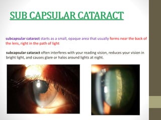 Cataract.pptx