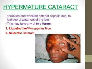 Cataract.pptx