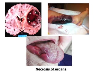 Necrosis of organs
 