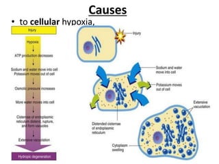 Causes
• to cellular hypoxia,
 