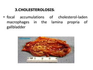 • focal accumulations of cholesterol-laden
macrophages in the lamina propria of
gallbladder
3.CHOLESTEROLOSIS:
 