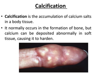 Calcification
• Calcification is the accumulation of calcium salts
in a body tissue.
• It normally occurs in the formation of bone, but
calcium can be deposited abnormally in soft
tissue, causing it to harden.
 