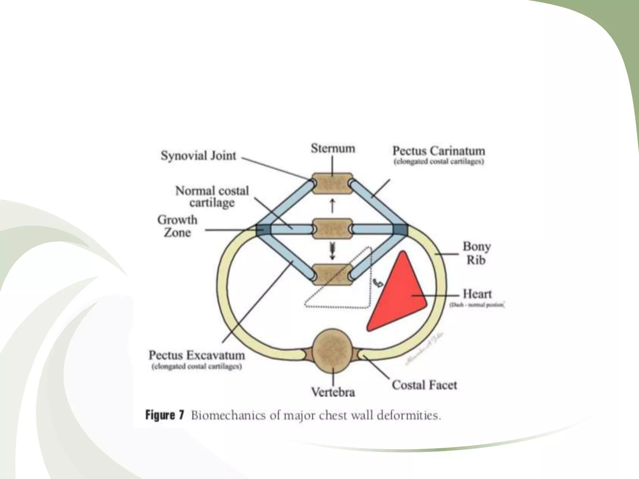 Congenital Chest Wall Abnormality | PPTX