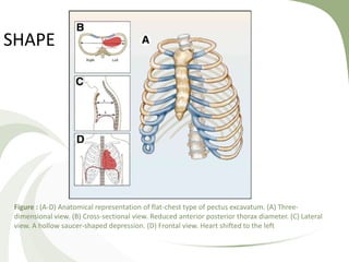 Figure : (A-D) Anatomical representation of flat-chest type of pectus excavatum. (A) Three-
dimensional view. (B) Cross-sectional view. Reduced anterior posterior thorax diameter. (C) Lateral
view. A hollow saucer-shaped depression. (D) Frontal view. Heart shifted to the left
SHAPE
 