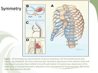 Figure : (A-D) Anatomical representation of pectus excavatum. (A) Three-dimensional view.
Classic, cup-shaped PE. (B) Cross-sectional view. Symmetric depression of the anterior chest wall.
Cup-shaped concavity. Heart shifted to the left and rotated. (C) Lateral view. Depression of the
lower third of mesosternum with a reduction in the anteroposterior thorax diameter. (D) Frontal
view. Heart shifted to the left.
Symmetry
 