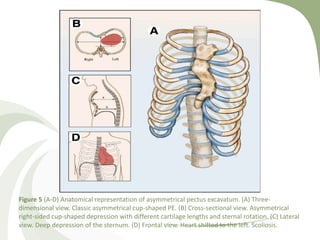 Figure 5 (A-D) Anatomical representation of asymmetrical pectus excavatum. (A) Three-
dimensional view. Classic asymmetrical cup-shaped PE. (B) Cross-sectional view. Asymmetrical
right-sided cup-shaped depression with different cartilage lengths and sternal rotation. (C) Lateral
view. Deep depression of the sternum. (D) Frontal view. Heart shifted to the left. Scoliosis.
 