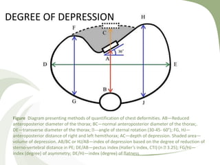 Figure Diagram presenting methods of quantification of chest deformities. AB—Reduced
anteroposterior diameter of the thorax; BC—normal anteroposterior diameter of the thorax;.
DE—transverse diameter of the thorax; 􏰀---angle of sternal rotation (30-45- 60°); FG, HJ—
anteroposterior distance of right and left hemithorax; AC—depth of depression. Shaded area—
volume of depression. AB/BC or HJ/AB—index of depression based on the degree of reduction of
sterno-vertebral distance in PE; DE/AB—pectus index (Haller’s index, CTI) (n 􏰀 3.25); FG/HJ—
index (degree) of asymmetry; DE/HJ—index (degree) of flatness
DEGREE OF DEPRESSION
 