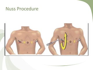 Nuss Procedure
 