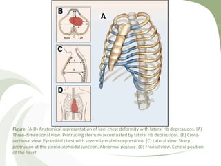 Figure (A-D) Anatomical representation of keel chest deformity with lateral rib depressions. (A)
Three-dimensional view. Protruding sternum accentuated by lateral rib depressions. (B) Cross-
sectional view. Pyramidal chest with severe lateral rib depressions. (C) Lateral view. Sharp
protrusion at the sterno-xiphoidal junction. Abnormal posture. (D) Frontal view. Central position
of the heart.
 