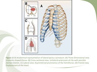 Figure (A-D) Anatomical representation of lateral pectus carinatum. (A) Three-dimensional view.
Unevenly shaped thorax. (B) Cross-sectional view. Unilateral protrusion of ribs with possible
sternal rotation. (C) Lateral view. Asymmetrical prominence of the hemithorax. (D) Frontal view.
Displacement of the heart.
 