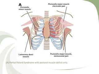 (A) Partial Poland Syndrome with pectoral muscle deficit only.
 