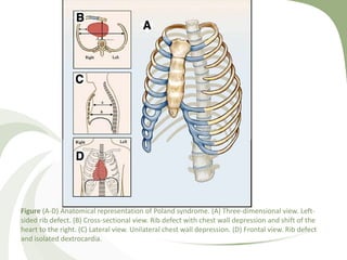 Figure (A-D) Anatomical representation of Poland syndrome. (A) Three-dimensional view. Left-
sided rib defect. (B) Cross-sectional view. Rib defect with chest wall depression and shift of the
heart to the right. (C) Lateral view. Unilateral chest wall depression. (D) Frontal view. Rib defect
and isolated dextrocardia.
 