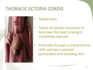 THORACIC ECTOPIA CORDIS
35
• Naked heart
• Failure of somatic structures to
form over the heart Leaving it
completely exposed.
• Protrudes through a central sternal
cleft and lack a parietal
pericardium and overlying skin.
 