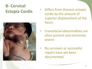 B- Cervical
Ectopia Cordis
36
• Differs from thoracic ectopia
cordis by the amount of
superior displacement of the
heart.
• Craniofacial abnormalities are
often present and extremely
severe
• No survivors or successful
repairs have yet been
documented.
 