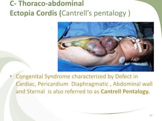 C- Thoraco-abdominal
Ectopia Cordis (Cantrell’s pentalogy )
• Congenital Syndrome characterized by Defect in
Cardiac, Pericardium Diaphragmatic , Abdominal wall
and Sternal is also referred to as Cantrell Pentalogy.
37
 