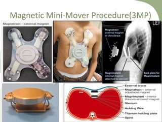 Magnetic Mini-Mover Procedure(3MP)
 
