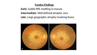 Comprehensive Overview of Choroidal Dystrophies: Genetics, Clinical ...