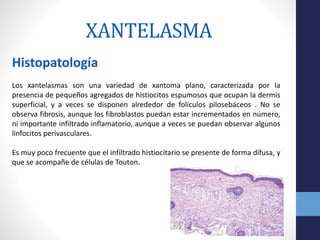 Los xantelasmas son una variedad de xantoma plano, caracterizada por la
presencia de pequeños agregados de histiocitos esp...