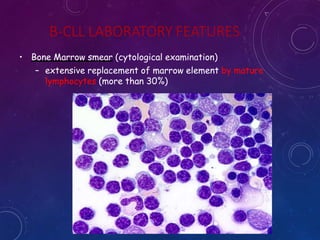 B-CLL LABORATORY FEATURES
• Bone Marrow smear (cytological examination)
– extensive replacement of marrow element by mature
lymphocytes (more than 30%)
 