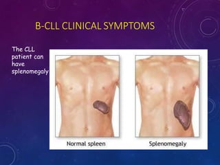 B-CLL CLINICAL SYMPTOMS
The CLL
patient can
have
splenomegaly
 