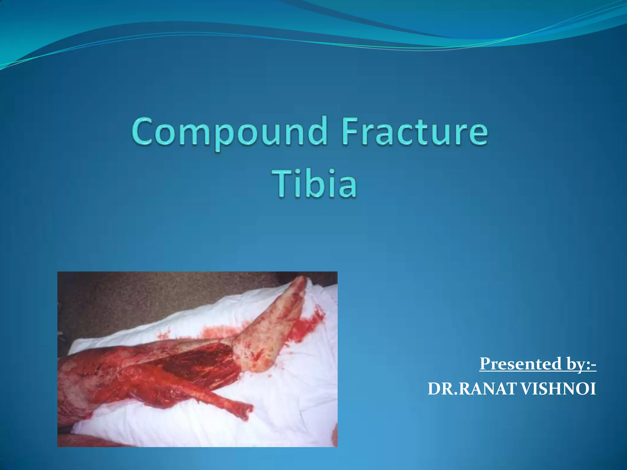 Compound Fracture Tibia | PPTX