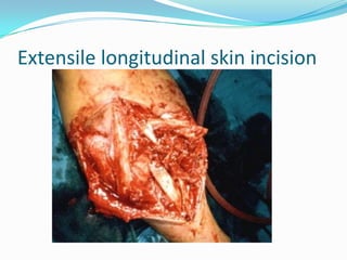 Extensile longitudinal skin incision
 