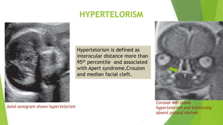 Interocular Distance Mri Congenital anomalies of head,neck and face(Radiology) including USG and ...