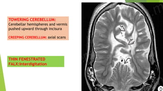 Moderate Cerebral Involution MRI evaluation of developing brain and its role in congenital brain ...