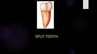 Cracks in Endodontics | PPTX