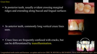 Cracks in Endodontics | PPTX