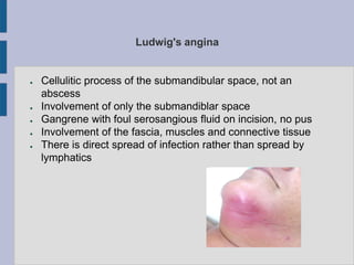 Ludwig's angina
● Cellulitic process of the submandibular space, not an
abscess
● Involvement of only the submandiblar space
● Gangrene with foul serosangious fluid on incision, no pus
● Involvement of the fascia, muscles and connective tissue
● There is direct spread of infection rather than spread by
lymphatics
 