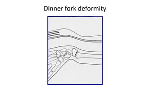 Distorted Fork Fractures of distal end radius management | PPTX