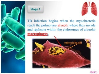 Stage 1


TB infection begins when the mycobacteria
reach the pulmonary alveoli, where they invade
and replicate within the endosomes of alveolar
macrophages.

                        tubercle bacilli




                                           Ref(1)
 