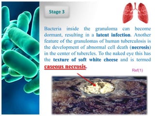 Stage 3


Bacteria inside the granuloma can become
dormant, resulting in a latent infection. Another
feature of the granulomas of human tuberculosis is
the development of abnormal cell death (necrosis)
in the center of tubercles. To the naked eye this has
the texture of soft white cheese and is termed
caseous necrosis.
                                           Ref(1)
 