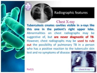2

                     Radiographic features

                      Chest X-ray
Tuberculosis creates cavities visible in x-rays like
this one in the patient's right upper lobe.
Abnormalities on chest radiographs may be
suggestive of, but are never diagnostic of TB.
However, chest radiographs may be used to rule
out the possibility of pulmonary TB in a person
who has a positive reaction to the tuberculin skin
test and no symptoms of disease.




Ref(2)                                  Chest X-ray
 