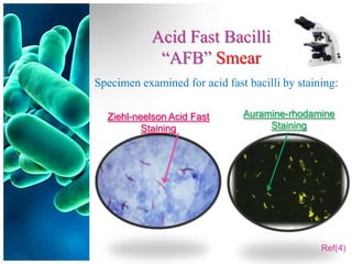 Acid Fast Bacilli
             “AFB” Smear
Specimen examined for acid fast bacilli by staining:

  Ziehl-neelson Acid Fast      Auramine-rhodamine
          Staining                  Staining




                                                Ref(4)
 